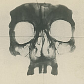 Human skull, X-ray