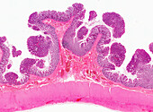 Colon polyps, light micrograph