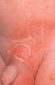 Staphylococcal in impetigo neonate