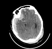 Traumatic brain injuries, CT scan
