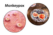 Monkeypox infection and virus, illustration