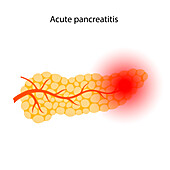 Acute pancreatitis, illustration