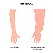Lymphoedema of arm, illustration