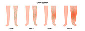 Stages of lymphoedema, illustration