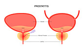Prostatitis, illustration