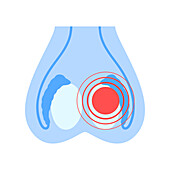 Testicular cancer, illustration