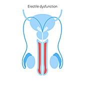Erectile dysfunction, illustration