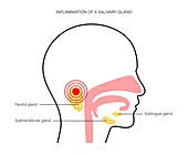 Salivary gland inflammation, illustration