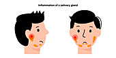 Salivary gland inflammation, illustration