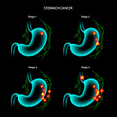 Stomach cancer, illustration