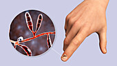 Fungal nail infection, illustration