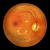 Retina damage from diabetes, illustration