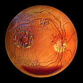 Retina damage from diabetes, illustration