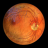 Retina damage from diabetes, illustration