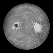 Retina damage from diabetes, illustration