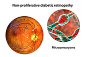 Retina damage from diabetes, illustration