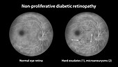 Retina damage from diabetes, illustration
