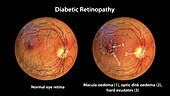 Retina damage from diabetes, illustration