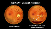 Retina damage from diabetes, illustration