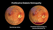 Retina damage from diabetes, illustration