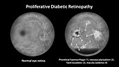 Retina damage from diabetes, illustration