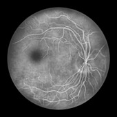 Fluorescein angiogram of an eye retina, illustration