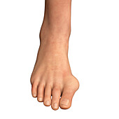 Bunion, illustration