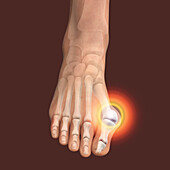 Bunion, illustration