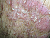 Epidermolysis bullosa acquisita