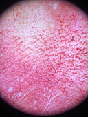 Rosacea, dermoscopy