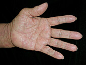 Urticarial vasculitis