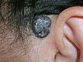 Pigmented basal cell carcinoma