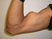 Ruptured biceps tendon