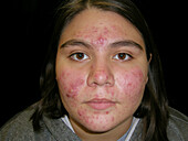 Cystic acne