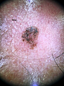 Melanoma in situ, dermoscopy