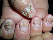 Median nail dystrophy on all fingernails