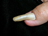 Pincer nails