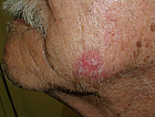 Actinic keratosis