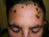 Discoid lupus erythematosus