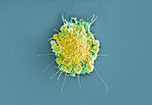 Cervical cancer cell, SEM