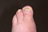 Congenital absence of two toes