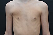 Congenital chest deformity