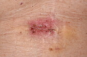 Scar after cancer removal