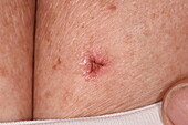Treatment of superficial basal cell carcinoma