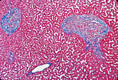 Liver fibrosis, light micrograph