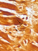 Lyme disease bacteria in heart tissue, light micrograph