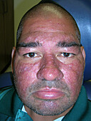 Acne rosacea