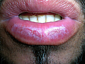 Actinic cheilitis after treatment