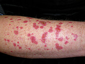 Treatment of actinic keratoses