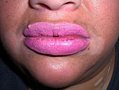 Swollen lips
